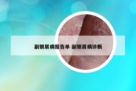 副银屑病报告单 副银屑病诊断