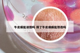 牛皮癣能请假吗 得了牛皮病癣能熬夜吗