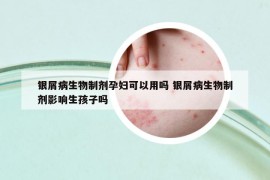 银屑病生物制剂孕妇可以用吗 银屑病生物制剂影响生孩子吗