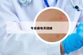 牛皮癣每天挠破
