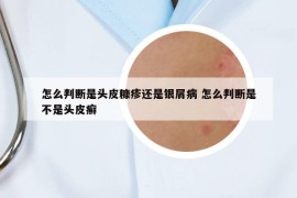 怎么判断是头皮糠疹还是银屑病 怎么判断是不是头皮癣