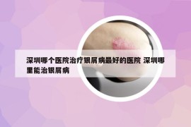 深圳哪个医院治疗银屑病最好的医院 深圳哪里能治银屑病
