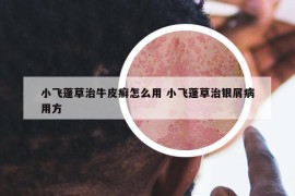 小飞蓬草治牛皮癣怎么用 小飞蓬草治银屑病用方