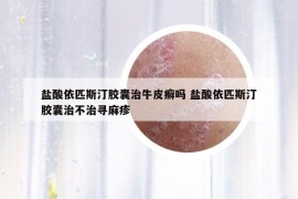 盐酸依匹斯汀胶囊治牛皮癣吗 盐酸依匹斯汀胶囊治不治寻麻疹