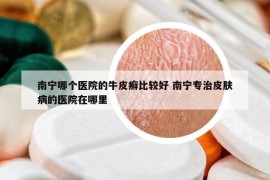 南宁哪个医院的牛皮癣比较好 南宁专治皮肤病的医院在哪里