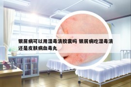 银屑病可以用湿毒清胶囊吗 银屑病吃湿毒清还是皮肤病血毒丸
