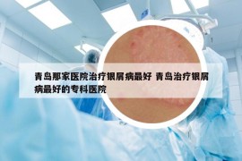 青岛那家医院治疗银屑病最好 青岛治疗银屑病最好的专科医院