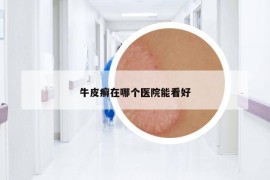 牛皮癣在哪个医院能看好