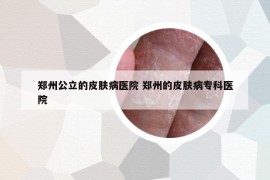 郑州公立的皮肤病医院 郑州的皮肤病专科医院