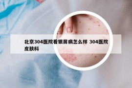 北京304医院看银屑病怎么样 304医院皮肤科