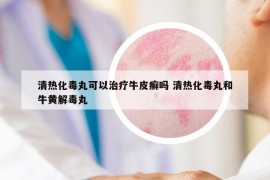 清热化毒丸可以治疗牛皮癣吗 清热化毒丸和牛黄解毒丸