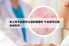 身上有牛皮癣可以涂防晒霜吗 牛皮癣可以摸身体乳吗