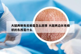 大腿两侧有皮癣是怎么回事 大腿两边长有癣状的东西是什么