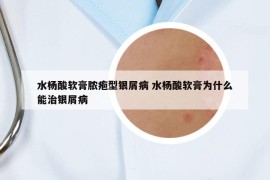 水杨酸软膏脓疱型银屑病 水杨酸软膏为什么能治银屑病