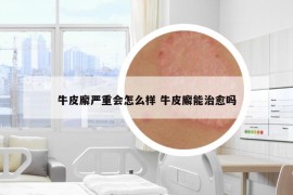 牛皮廨严重会怎么样 牛皮廨能治愈吗