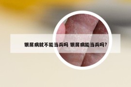 银屑病就不能当兵吗 银屑病能当兵吗?