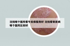沈阳哪个医院看牛皮癣服务好 沈阳看银屑病哪个医院比较好