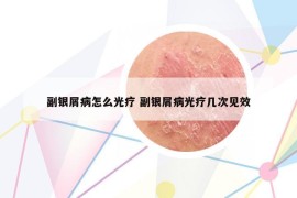 副银屑病怎么光疗 副银屑病光疗几次见效