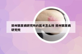 郑州银屑病研究所的医术怎么样 郑州银屑病研究院