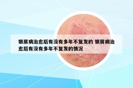 银屑病治愈后有没有多年不复发的 银屑病治愈后有没有多年不复发的情况