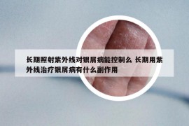 长期照射紫外线对银屑病能控制么 长期用紫外线治疗银屑病有什么副作用