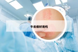 牛皮癣好用吗