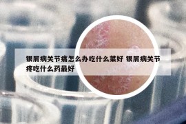 银屑病关节痛怎么办吃什么菜好 银屑病关节疼吃什么药最好