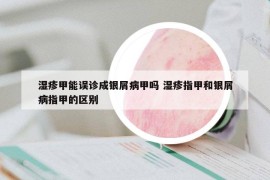 湿疹甲能误诊成银屑病甲吗 湿疹指甲和银屑病指甲的区别