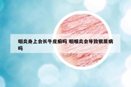 咽炎身上会长牛皮癣吗 咽喉炎会导致银屑病吗