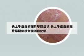 头上牛皮皮癣图片早期症状 头上牛皮皮癣图片早期症状食物活血化瘀
