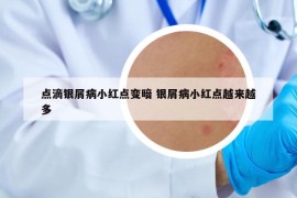 点滴银屑病小红点变暗 银屑病小红点越来越多