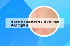 女儿5岁得了银屑病3个月了 孩子得了银屑病3月了还不好