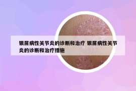 银屑病性关节炎的诊断和治疗 银屑病性关节炎的诊断和治疗措施