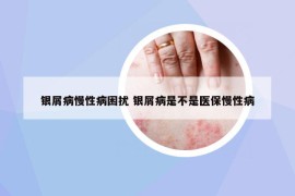 银屑病慢性病困扰 银屑病是不是医保慢性病