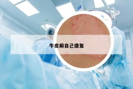 牛皮癣自己康复
