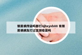 银屑病传染吗都打njhxyxb88 有银屑病病友打过宫颈疫苗吗