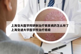 上海交大医学院研制治疗银屑病药怎么样了 上海交通大学医学院治疗癌症