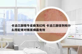 卡泊三醇擦牛皮癣发红吗 卡泊三醇搽剂和什么搭配用对银屑病最有效