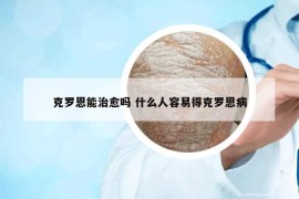 克罗恩能治愈吗 什么人容易得克罗恩病