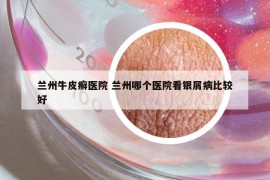 兰州牛皮癣医院 兰州哪个医院看银屑病比较好