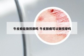牛皮癣能做按摩吗 牛皮肤癣可以做按摩吗