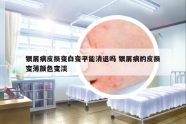 银屑病皮损变白变平能消退吗 银屑病的皮损变薄颜色变淡