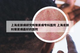 上海皮肤病研究所银屑病专科医院 上海皮肤科银屑病最好的医院