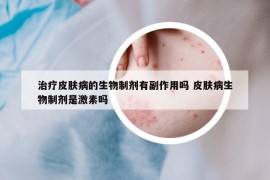 治疗皮肤病的生物制剂有副作用吗 皮肤病生物制剂是激素吗