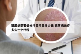银屑病需要做光疗费用是多少钱 银屑病光疗多久一个疗程