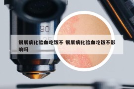 银屑病化验血吃饭不 银屑病化验血吃饭不影响吗