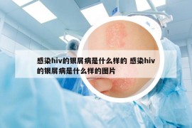 感染hiv的银屑病是什么样的 感染hiv的银屑病是什么样的图片