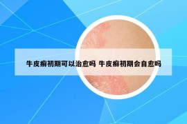 牛皮癣初期可以治愈吗 牛皮癣初期会自愈吗