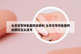 北京空军特色医院皮肤科 北京空军特色医院皮肤科怎么挂号