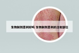 生物制剂恩利好吗 生物制剂恩利的注射部位